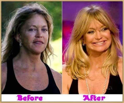 goldie hawn plastic surgery before and after celeb