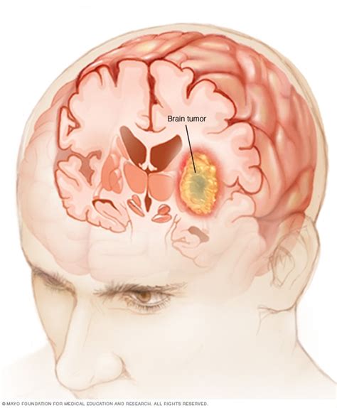 brain tumor symptoms   mayo clinic