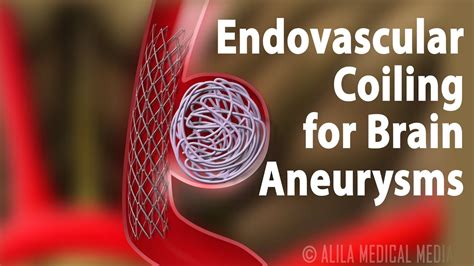 aneurysm coiling  underwent primary coil embolization