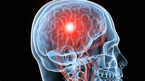 symptoms  traumatic brain injury show  years   injury