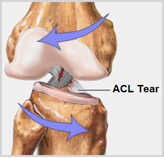 acl knee injury  symptoms treatment knee pain explained