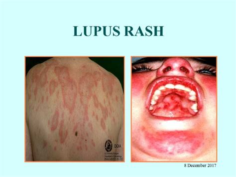 systemic lupus erythematosus sle  december  definition