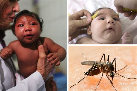 breaking head shrinking virus zika in ireland after first