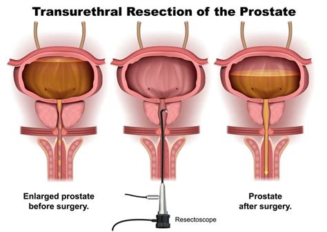 Users Guide To The Prostate Online Prescription Medications