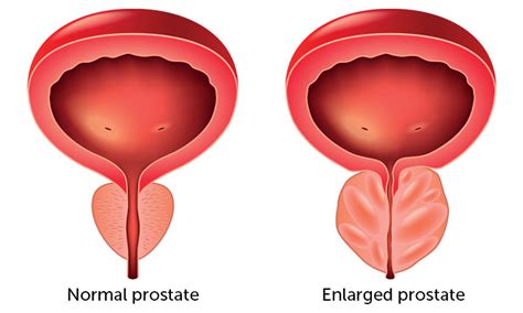 Benign Prostatic Hyperplasia Health Plus