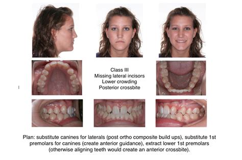 Class Iii Treatment Photos Orthodontics Cary Nc Clayton Nc