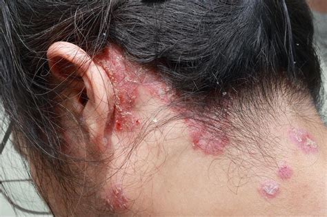 scalp psoriasis vs dandruff differences symptoms and treatment
