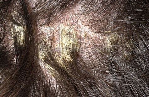 dry scalp scalp psoriasis pinterest