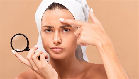 chemical peels  acne sanjiva medical spa dallas