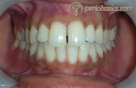 gingival health normal periodontium gingival color contour consistency