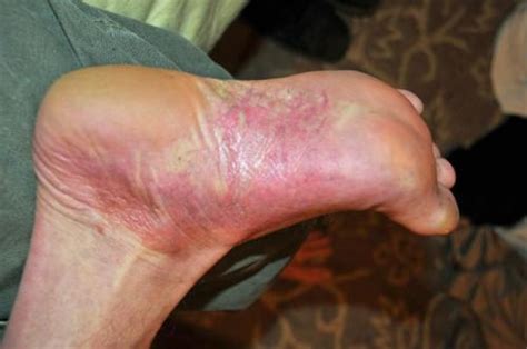 Hand Foot Psoriasis Pictures Psoriasis Inspire