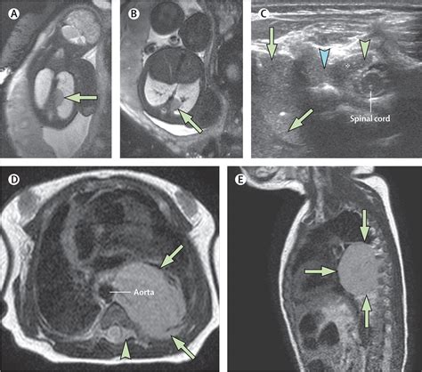 Neonatal Cancer The Lancet Oncology