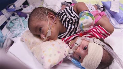 First Look At Conjoined Twins Born In Texas Abc7 Chicago