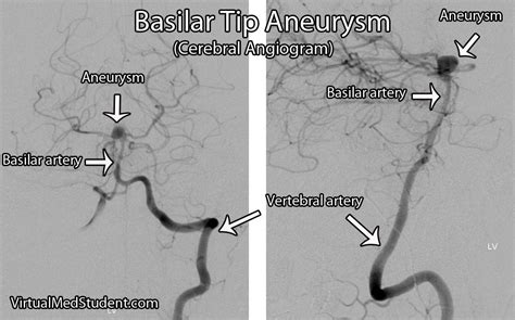 virtualmedstudentcom basilar artery aneurysms aneurysm arteries
