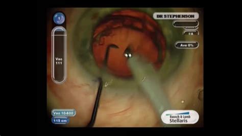 Femtosecond Laser Assisted Cataract Surgery Technique