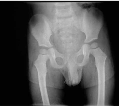 Plain Urinary Tract X Ray Image Showing A Stone Located In