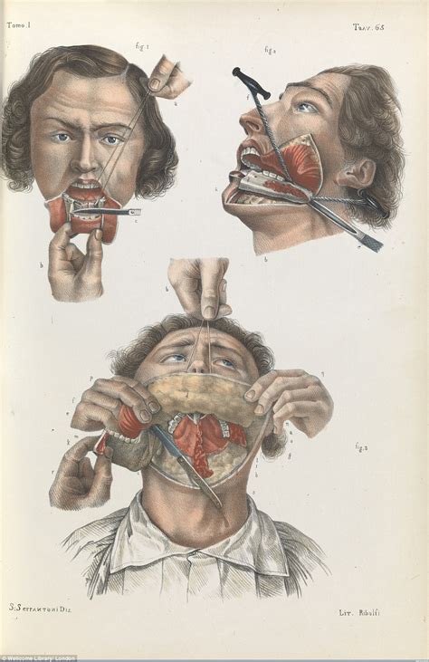wellcome collection s images show the barbaric nature of 19th century surgery daily mail online