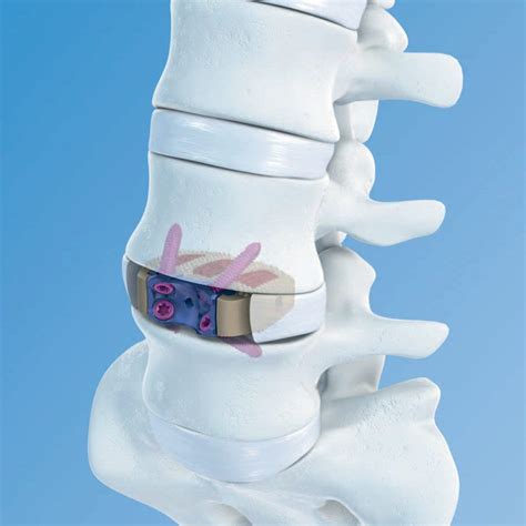 Lumbar Interbody Fusion Cage Synfix Lr Depuy Synthes