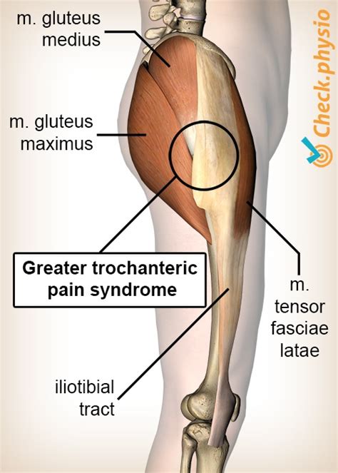 greater trochanteric pain syndrome physio check