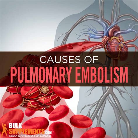 Pulmonary Embolism Causes Symptoms And Treatment By James Denlinger
