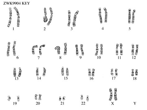 Trisomy 18 Home