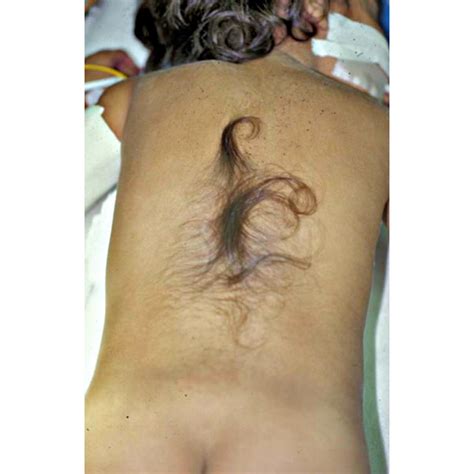 Spina bifida occulta hairy patch