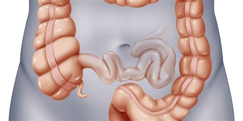 polyps in the colon large bowel