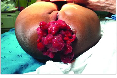 Prolapsed Rectum Demonstrating Rectal Polyposis