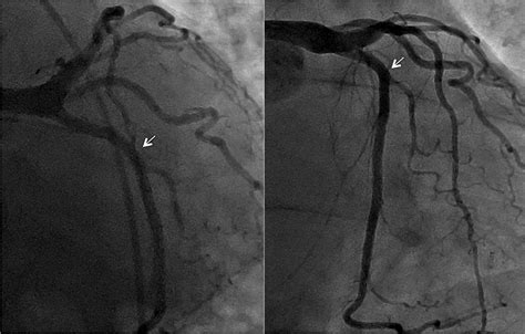 cureus iatrogenic circumflex artery stenosis  mitral valve repair