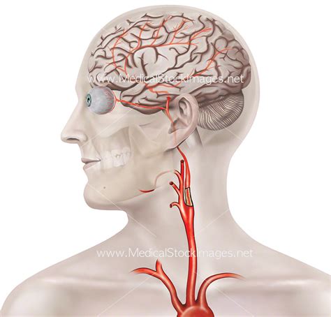 blockage   carotid artery medical stock images company