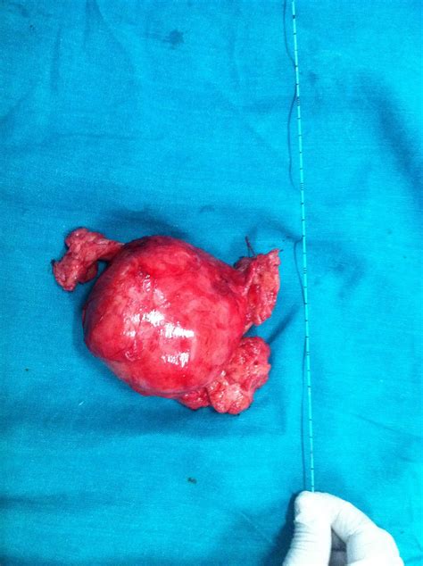 Ramayya Pramila Urology Hospital Largest Prostate Gland Removal In