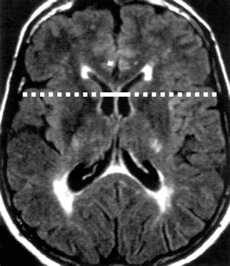 bicaudate ratio as a magnetic resonance imaging marker of brain atrophy in multiple sclerosis