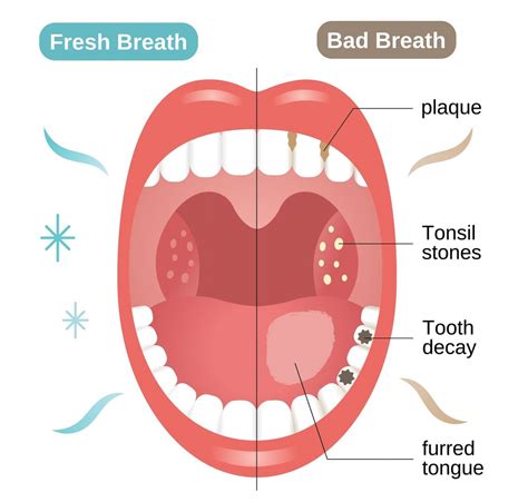 how to cure bad breath permanently the holistic approach