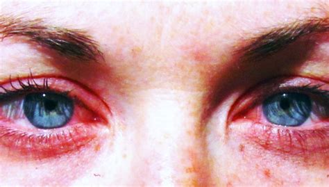 alergias en los ojos previenelos clinica peruana de la vision clinica peruana de la vision