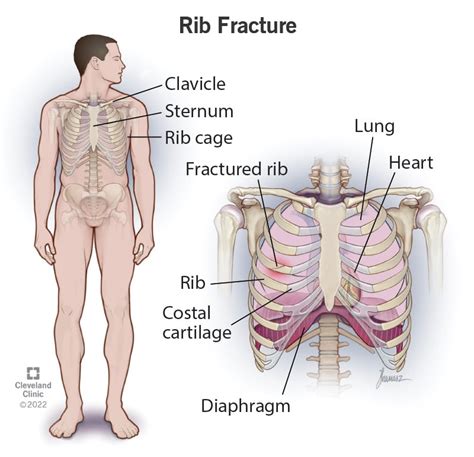 Rib Fracture Broken Rib Symptoms Healing Tips And Treatment