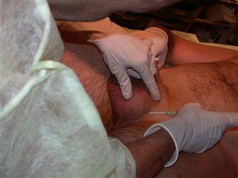 orchiectomy surgery tumblr