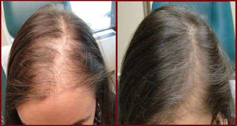Vampire Hair Restoration Misbiw ⎮ Medical Innovative Solutions For
