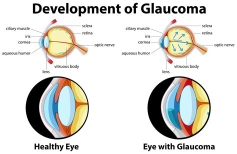 glaucoma  vector art   downloads