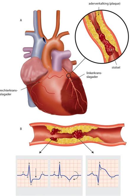hartinfarct acuut coronair syndroom hart long centrum leiden