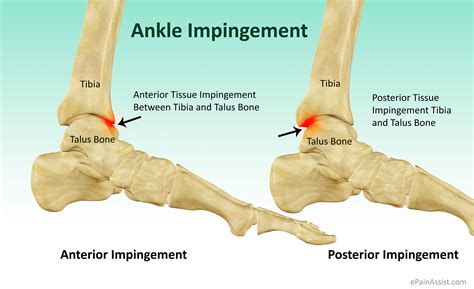 anterior ankle impingement book   podiatry hq clinics today