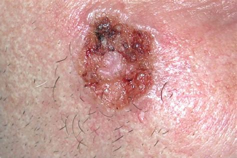 basal cell carcinoma treatment