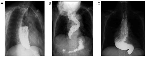 Influence Of Esophageal Morphology On The Clinical Efficacy Of Peroral