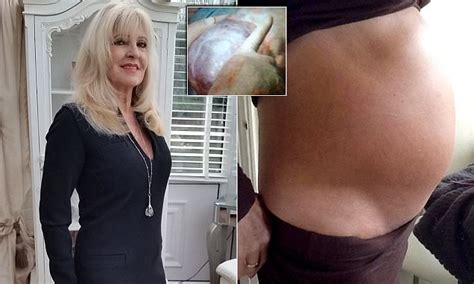 essex woman who looked pregnant is found to have 2 stone cyst daily mail online