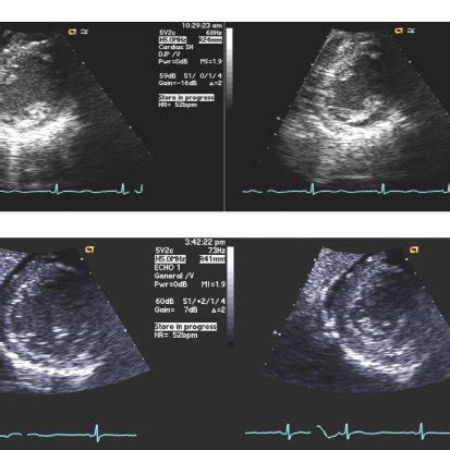 transthoracic echocardiogram tte  initial tte left ventricular  scientific