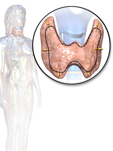 thyroid disease wiki everipedia