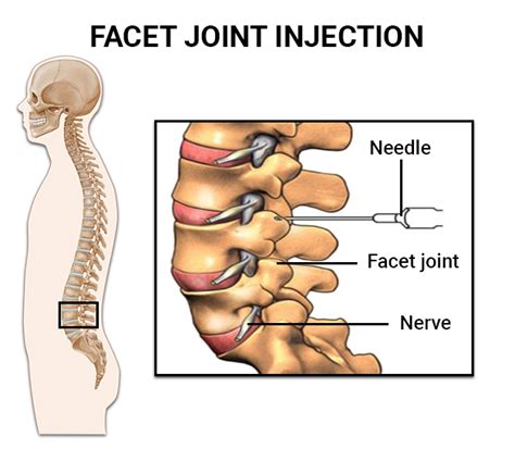 facet joint injections  spine rehab group