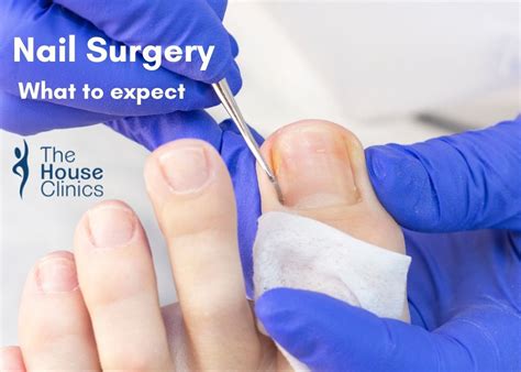 toenail surgery  complete guide  patients