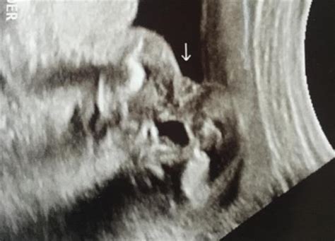 install wrong gender ultrasound 2019