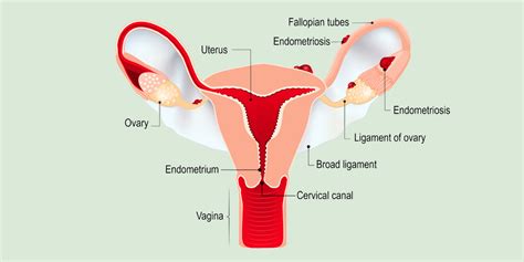 Endometriosis Infertility And Ivf Treatment North Cyprus Ivf