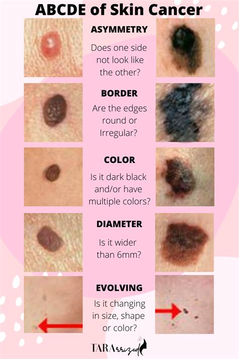 Abcde S Of Skin Cancer What You Need To Know Tararrized Sexiz Pix